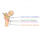 img Classification fracture massif trochant�rien