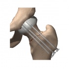 img Vissage percutan� fracture du col f�moral Garden 2