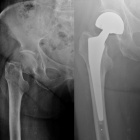 img Fracture col f�moral Garden 3 droite et PIH ciment�e