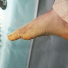 img Arthrod�se de l