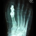 img Arthrod�se de l�articulation par plaque 