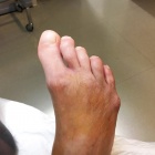 img Arthrose et coup de vent des orteils 