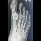img Arthrose et coup de vent des orteils 