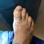 img arthrod�se et ost�otomie m�tatarsienne de r�alignement 