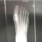 img Radiographie post op�ratoire 
