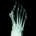 img Hallux Valgus