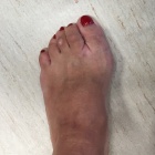 img Hallux Valgus
