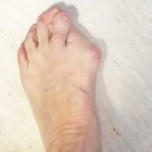 img Griffe du deuxieme orteil sur hallux valgus 