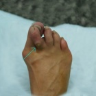 img Cor dorsal sur griffe IPP supra-adductus
