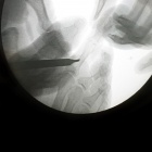 img Ost�otomie de la phalange