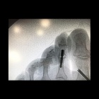 img Arthrod�se IPP de l